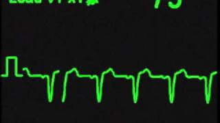 Left Bundle Branch Block  ECG Simulator  Arrhythmia Simulator [upl. by Alaek]