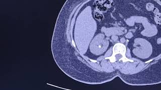 Renal ureteric stone hydronephrosis and renal swelling CT findings [upl. by Remas]