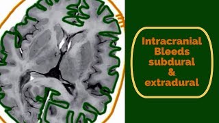 Intracranial bleeds Subdural and Extradural haematoma [upl. by Nerek677]