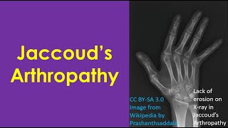 Jaccoud’s Arthropathy [upl. by Milson454]