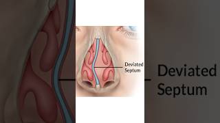 Is it worth it to fix a Deviated Septum  Capital ENT amp Sinus Center [upl. by Urbannal]