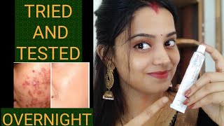 How to remove acne pimples within 2 days using this cream acne pimples removal ointment cream [upl. by Noivert612]