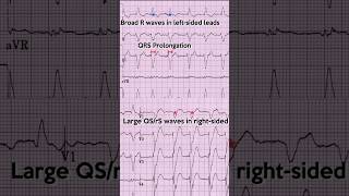 Left bundle branch block LBBB ECG Example 7 [upl. by Otilesoj]