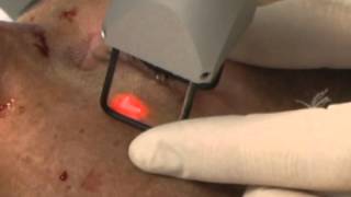 Fractional CO2 Skin Resurfacing with the SmartXide Laser [upl. by Marvella]