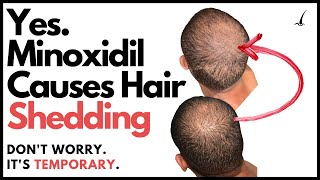 Does Minoxidil Make You Go Bald The TRUTH about Minoxidil Hair Shedding Phase [upl. by Adonis641]