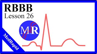 Right Bundle Branch Block RBBB [upl. by Mellar411]