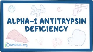 Alpha1 Antitrypsin Deficiency  causes symptoms diagnosis treatment pathology [upl. by Frances]