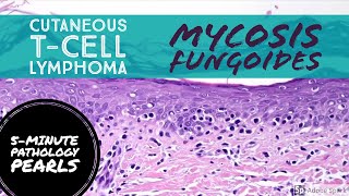 Mycosis Fungoides Cutaneous TCell Lymphoma 5Minute Pathology Pearls [upl. by Alanah411]