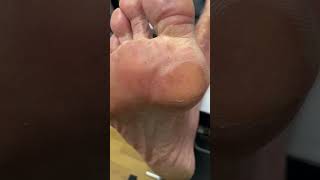 Join our Australian Podiatrist for a smooth journey of forefoot callus removal [upl. by Ravo]