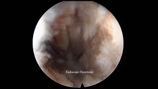 L5S1 endoscopic lumbar interbody fusion [upl. by Prouty]