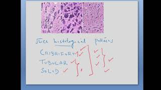 Adenoid Cystic Carcinoma Final 2024 [upl. by Kyle]