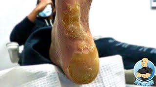 UNBELIEVABLE NEVER ENDING THICK FOOT CALLUSCALLOUS REMOVAL [upl. by Acisse]