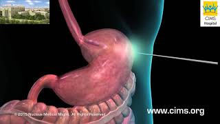 Percutaneous Endoscopic Gastrostomy PEG Feeding Tube Hindi  CIMS Hospital [upl. by Ynnej]