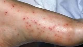 Comment traiter Pinpoint Petechiae [upl. by Sewellyn588]