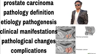 prostate carcinoma  prostate cancer  pathology notes  definitionetiologypathogenesishindi [upl. by Reiners]