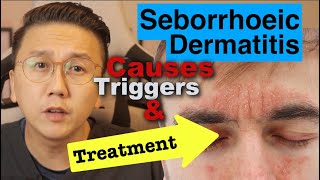 Seborrhoeic Dermatitis  Causes Triggers amp Treatment Options [upl. by Nolur]