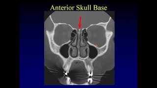 Imaging of the Paranasal Sinuses 1 [upl. by Fenton523]