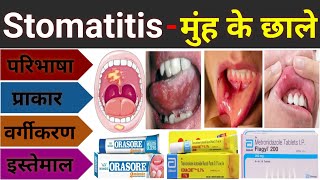 Mouth Ulcer Treatment  मुंह के छाले ठीक करने का आसान उपाय [upl. by Euqinad]