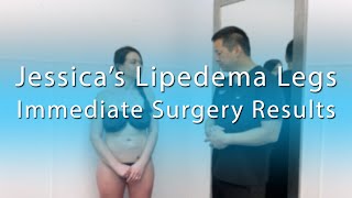 Lipedema Leg Liposuction Surgery Results  Lipo 360 Cankles amp Knees  ArtLipo  Expert Dr Thomas Su [upl. by Rol415]