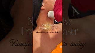 NonAblative Fractional Laser medandspaburrridge skinresurfacing scars stretchmarks wrinkles [upl. by Hairehcaz753]