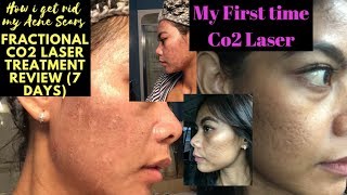 Acne Scars Removal First time Co2 laser treatment 7 Days Review [upl. by Atnes]