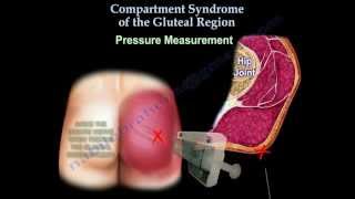 Compartment Syndrome Of The Gluteal Region  Everything You Need To Know  Dr Nabil Ebraheim [upl. by Yssis]