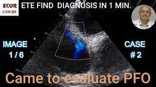 The Secret Differences Between PFO ASD Vena Cava and CSV [upl. by Sileray932]