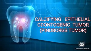 CALCIFYING EPITHELIAL ODONTOGENIC TUMOR PINDBORGS TUMOR [upl. by Dillie]