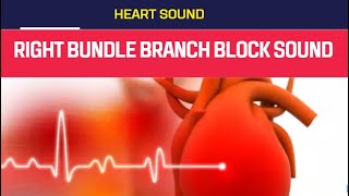 Right Bundle Branch Block Murmur sound Right Bundle Branch Block [upl. by Stevena]