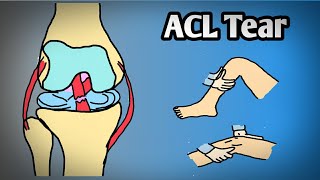 Anterior cruciate ligament tear in hindi amp English acltear kneepain sportinjury [upl. by Aicenek538]