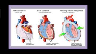 Cardiac Arrest Pulseless Electrical Activity [upl. by Atile546]