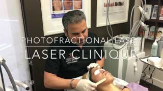 Photofractional Laser Resurfacing performed by Dr P Alexander Ataii at Laser Clinique in San Diego [upl. by Atews]