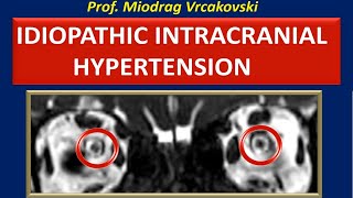 Idiopathic Intracranial Hypertension [upl. by Clo]