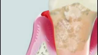 Cavitron on severe periodontitis [upl. by Celene566]