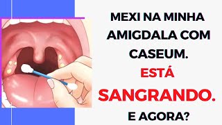 Caseo amigdaliano o que fazer quando a AMIGDALA SANGRA após cutucar mexer para tirar o caseum [upl. by Anidan963]