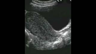 Huge Pelvis Mass In Young Nally Woman [upl. by Phio]