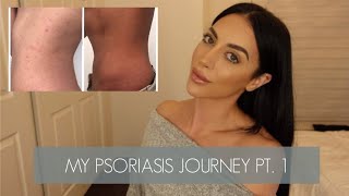 PSORIASIS JOURNEY PT 1  HOW I CLEARED MY PSORIASIS AND GOT MY LIFE BACK [upl. by Alodi]