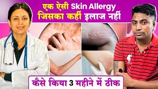 देखिये कैसे Skin Allergy URTICARIA का इलाज हुआ 3 महीनों में  URTICARIA Cure  Dr Upasana Vohra [upl. by Peddada]