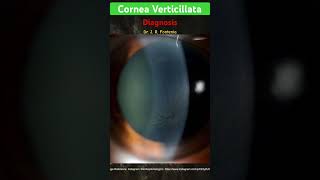 Cornea Verticillata Diagnosis’ [upl. by Ardaid]