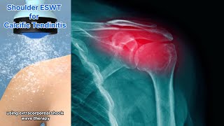 Calcific Tendinitis Of The Shoulder Extracorporeal Shock Wave Therapy May Be The Solution [upl. by Afatsom41]