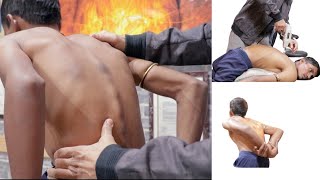 Extreme Ankylosing Spondylitis treatment by chiropractordr Pankaj choudhary [upl. by Imnubulo]