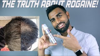 Minoxidil Beard Growth  3 Month Transformation  BEFORE and AFTER [upl. by Inattirb]