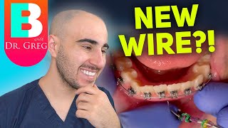 Braces Wire Tightening  Why amp How Your Orthodontist Changes Your Braces Wires [upl. by Aserahs]