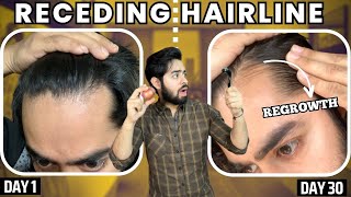 सिर्फ 1 महीने मैं RECEDING HAIRLINE REGROW करो  30 days HAIRLINE REGROWTH challenge [upl. by Notsek]