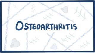 Osteoarthritis  causes symptoms diagnosis treatment amp pathology [upl. by Sitnalta]