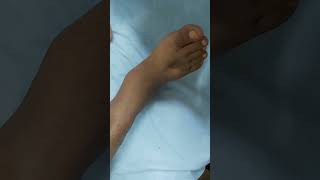 Pitting edema  DCLD patient clinicalexamination hospital doctor [upl. by Jaban797]