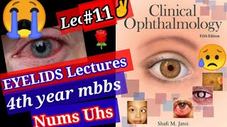 🔴Clinical Ophthalmology Lecture 11 Eyelids topic Entropion  inflammation of Eyelids [upl. by Eartha]