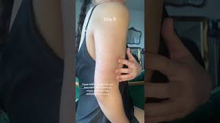 Kp update  keratosis pilaris chicken skin strawberry skin body care skincare tips journey hacks [upl. by Pigeon698]