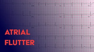 Atrial Flutter  EKG ECG Interpretation [upl. by Laucsap]