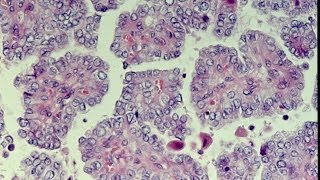 Thyroid Neoplasms  Pathology mini tutorial [upl. by Dabney416]